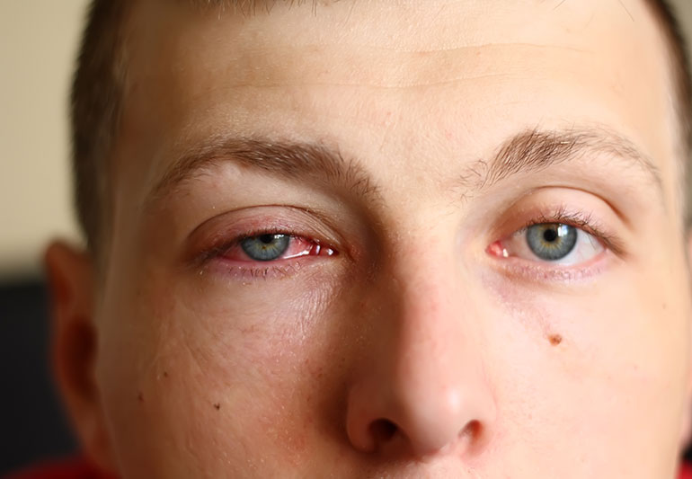 Pink Eye (Conjunctivitis)